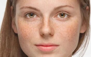 Pigmentation Treatment: Understanding the Cost and What to Expect